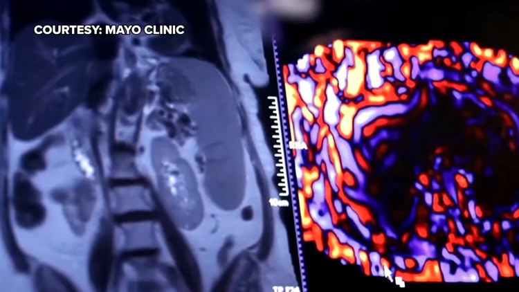 Healthy SA: Battling liver cancer, a disease which often has no symptoms early on — KENS 5 (San Antonio), Lisbon Health news